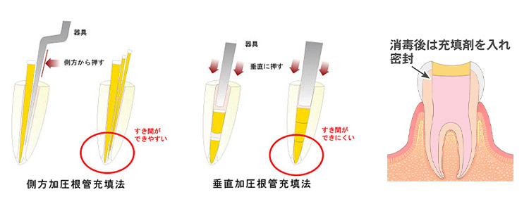 根管充填法