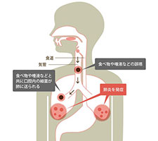 誤嚥性肺炎